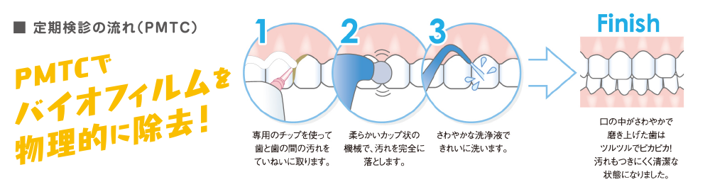 安藤歯科クリニックの定期検診（PMTC）