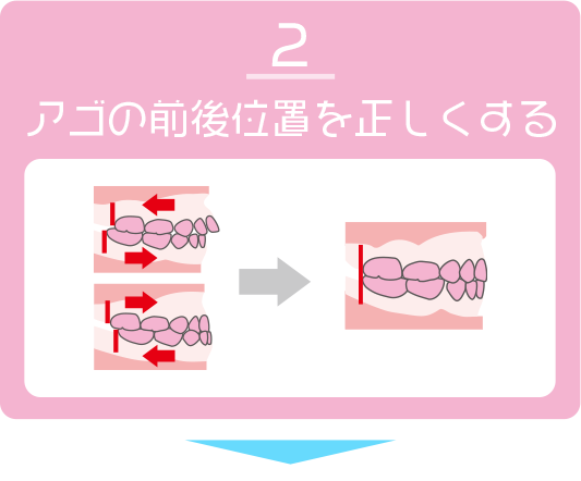 アゴの前後位置を正しくする